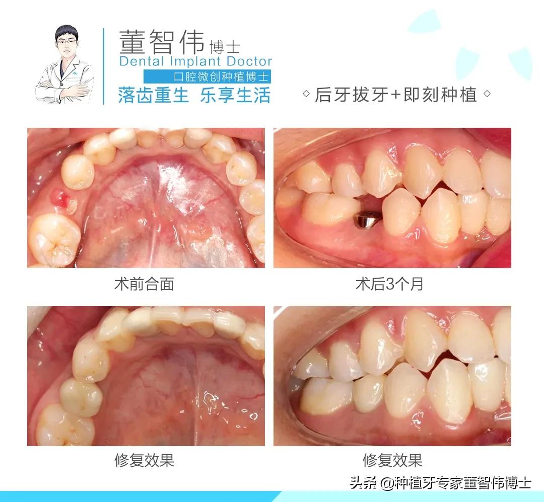 拔牙后即刻种植好还是延期种植好,拔牙后牙槽骨突的修复术视频