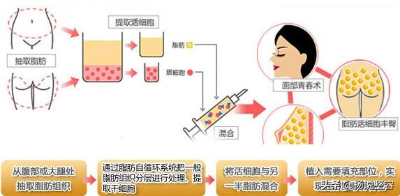 科普：自体脂肪面部填充有哪些优缺点、有哪些风险呢？