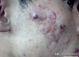 青春痘首选治疗方案是什么？答案都在这里了