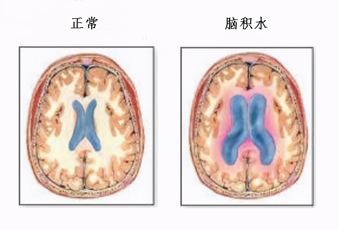 ct查出脑动脉瘤标注大小吗,ct检查脑室扩大别的没什么症状
