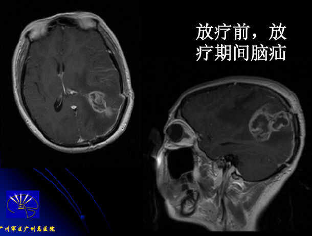 中医认为胶质瘤怎么来的,医学上什么叫胶质瘤