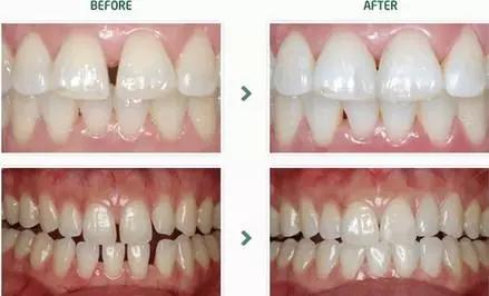 牙齿矫正拔牙后会反弹成原样么,牙齿矫正后反弹可以重新矫正吗