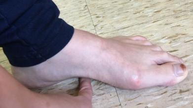 扁平足孩子的足部问题,儿童脚部知识