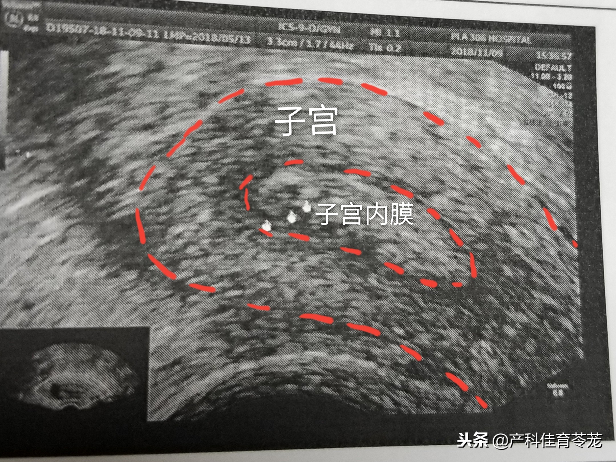 妇科b超检查正常需要做tct吗,妇科b超正常还要做阴镜吗