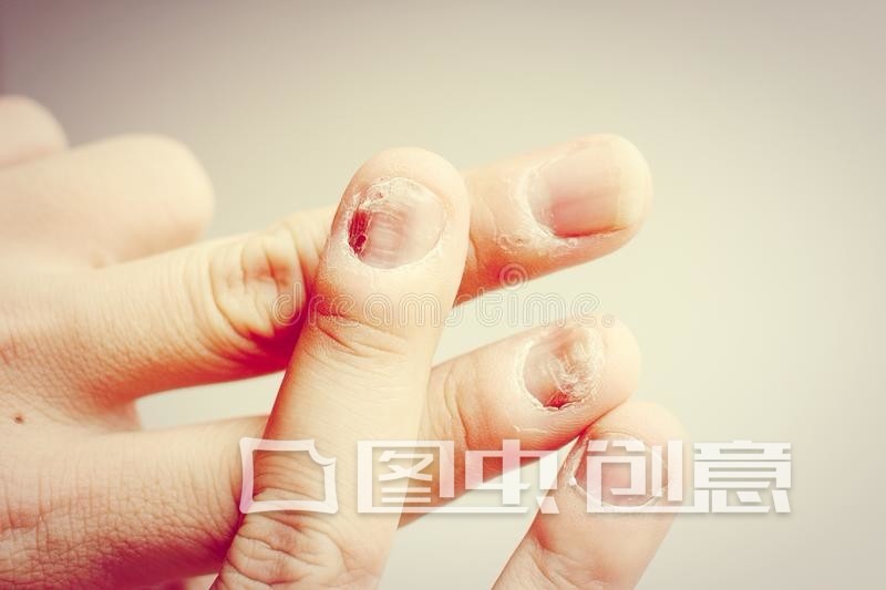 爱抠指甲是强迫症吗还是焦虑症,孩子抠指甲心理