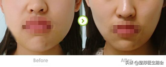 怎么改善大小脸不对称问题,左右脸严重不对称图片怎么改善