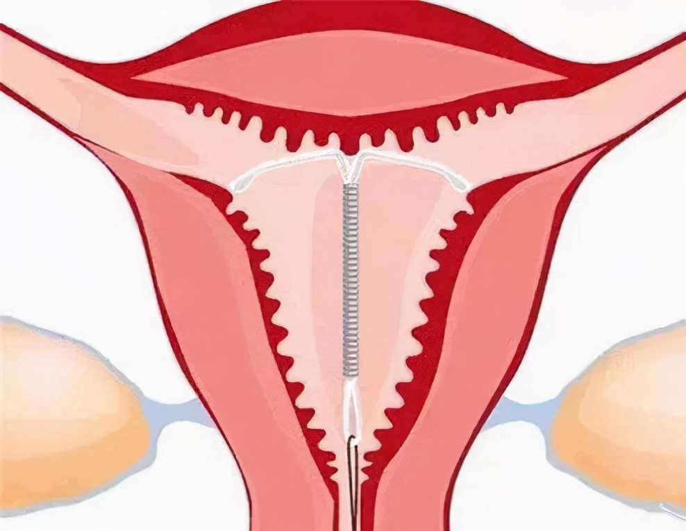 上环真有那么可怕吗,上环的误区