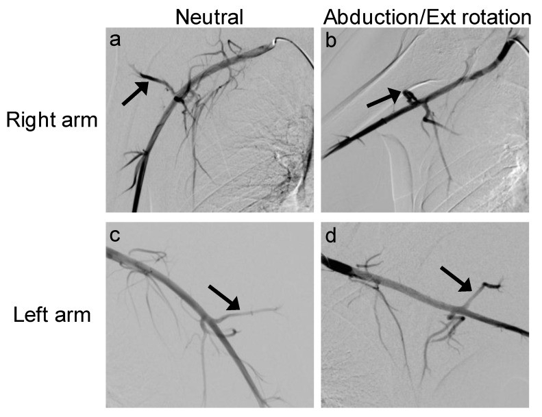 肩贞穴疼痛反应什么问题,肩膀酸困是内脏问题