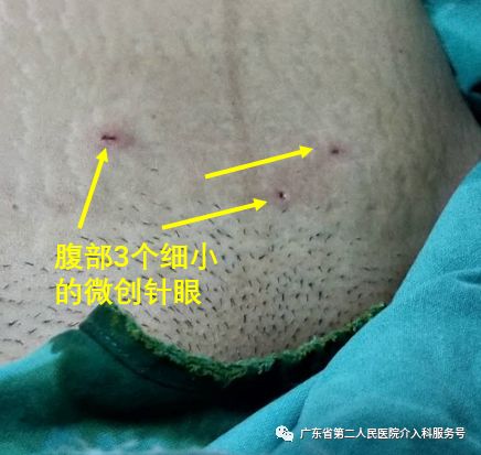 痛经消融手术,痛经微创