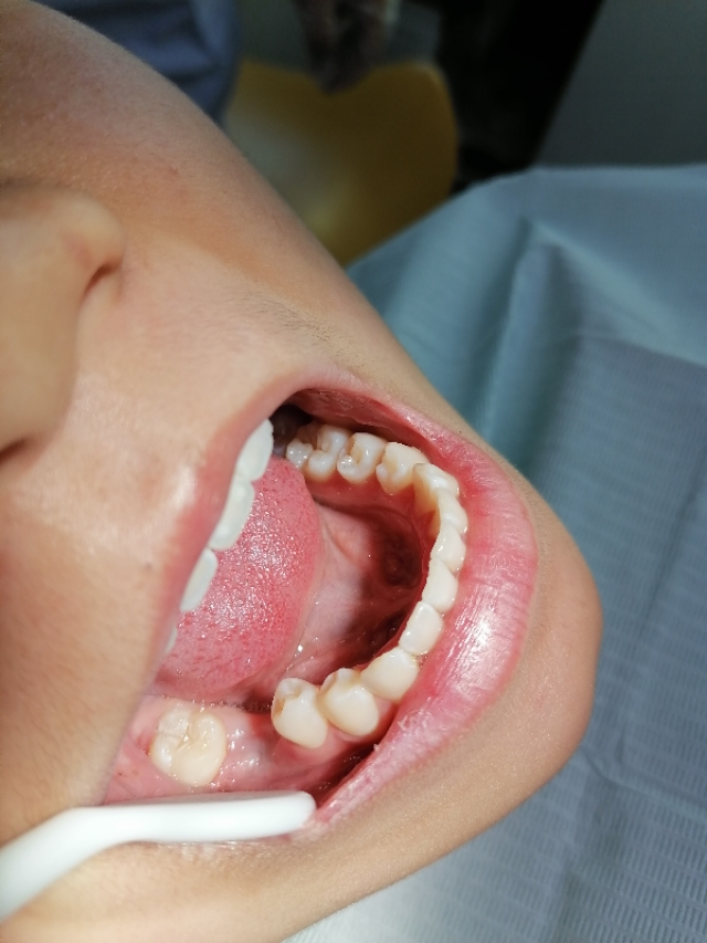 未成年人牙齿缺失怎么办,未成年人牙齿烂到不能补了怎么办