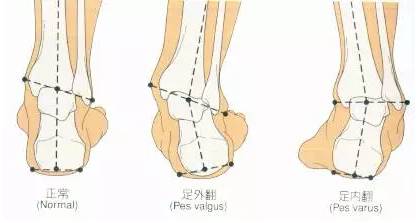 脑梗后脚内翻怎么办,脑梗后遗症脚内翻怎么治