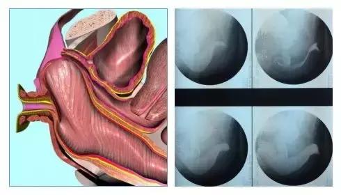 直肠前突便秘的症状是什么,直肠前突便秘如何通便