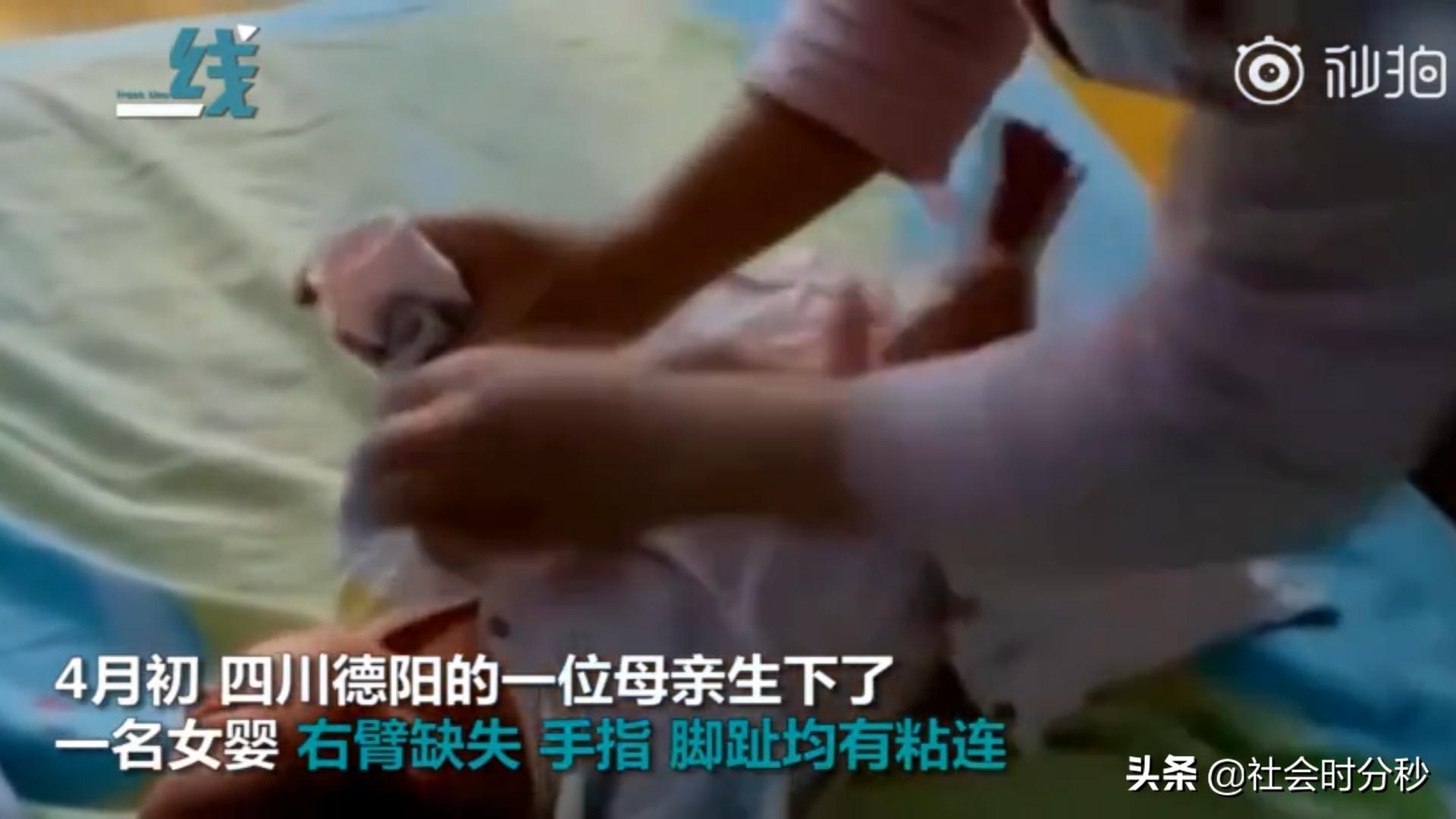 产检中发现胎儿手指缺失,孕检没查出来孩子生下来手指缺陷