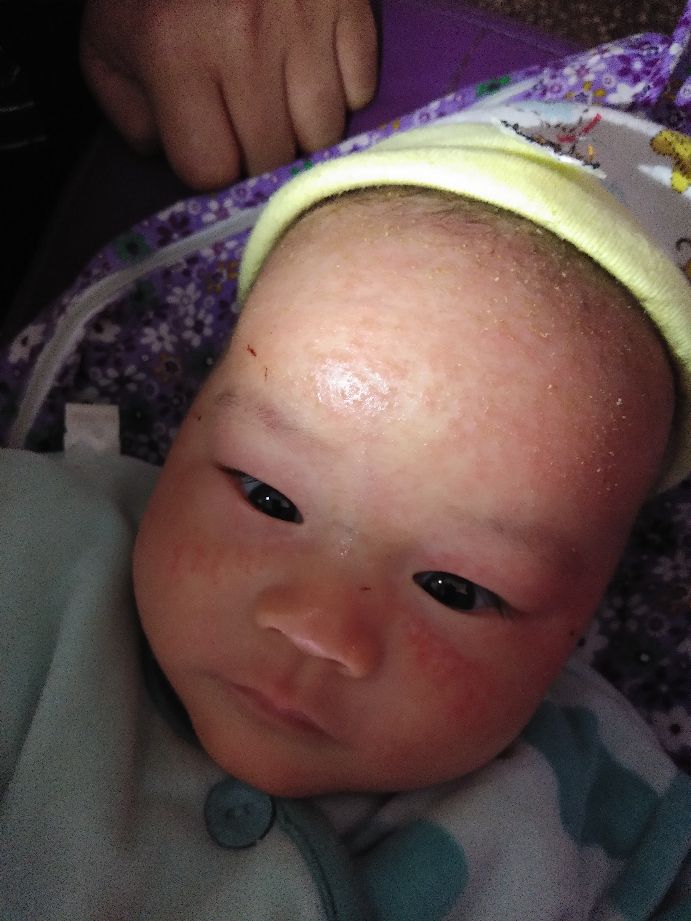 宝宝反复湿疹要崩溃了,湿疹宝宝一定是过敏体质吗