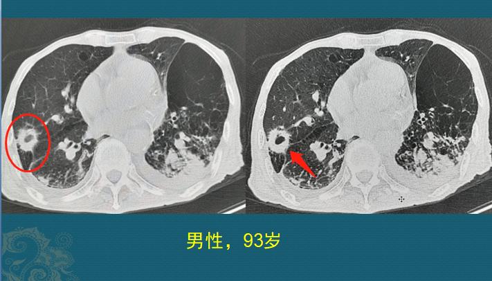 吃什么抗肺癌防癌最好,老年人肺癌晚期治疗成功案例