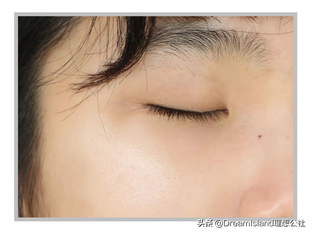 玻尿酸高光排名,打玻尿酸高光推荐