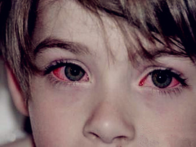 宝宝结膜炎如何照顾,宝宝结膜炎怎么快速治愈