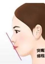 男人龅牙嘴突,龅牙导致的嘴凸怎么拯救