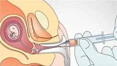 临沂妇幼绒毛穿刺,临沂羊膜腔穿刺术多少钱