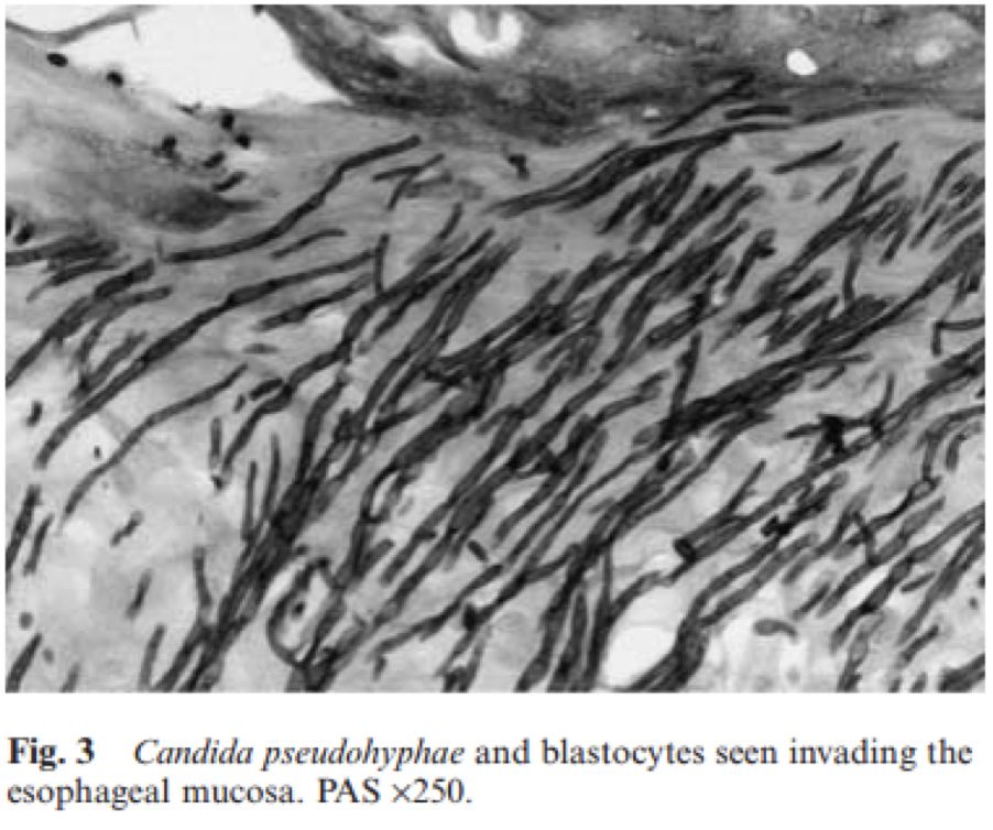 如何发现肺部真菌感染,怎样早期识别真菌感染