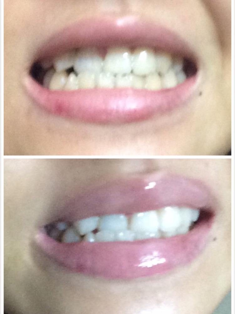 去除牙渍最好的牙膏,去牙渍亮白口气清新最好用的牙膏