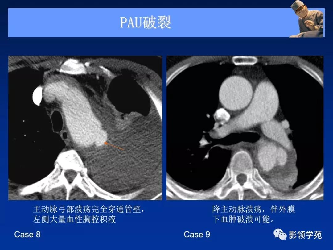 主动脉夹层壁间血肿如何鉴别,主动脉夹层血肿溃疡