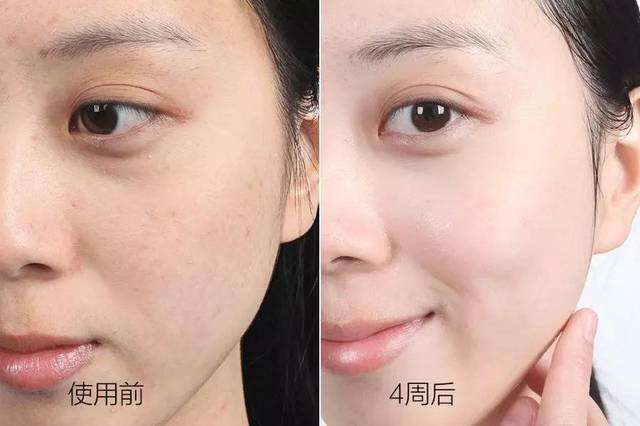 蜂蜜和开塞露搭配有什么效果,开塞露和蜂蜜去除斑点