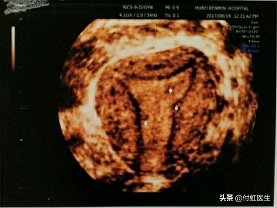 妇科之真相,为什么医院都推介无痛人流