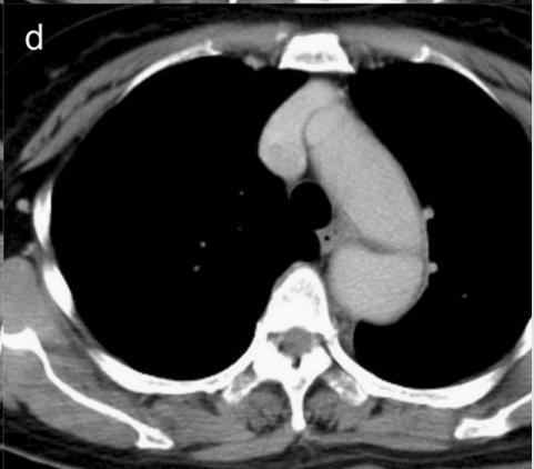 胸部Ct平扫能查出主动脉夹层吗,主动脉夹层cta影像图片解读