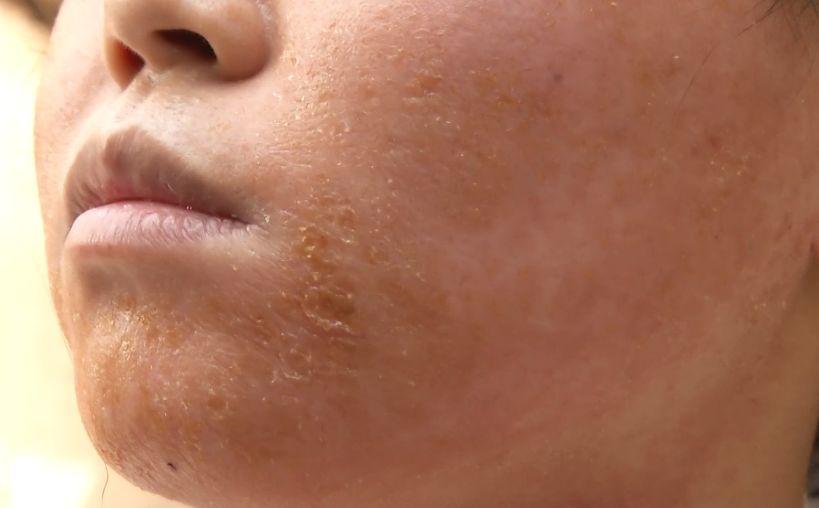 美容院回来脸上红肿痒怎么办,过敏脸部红肿痒美容院