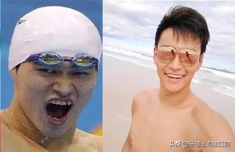 明星牙齿矫正前后对比,明星牙齿矫正都用的什么矫正方式