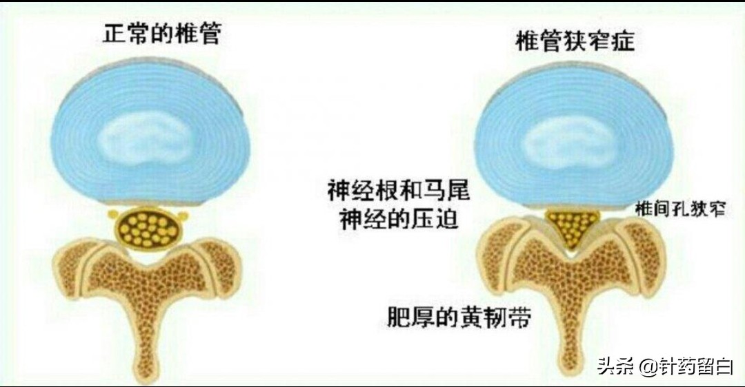 一文读懂靶向治疗,一文看懂椎体成形