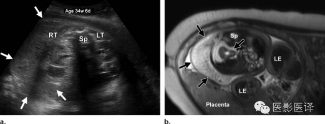 孕期发现卵巢囊肿有8cm左右,孕19周查出胎儿卵巢囊肿