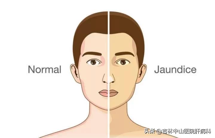 胆红素升高怎么办,胆红素升高怎么办呢