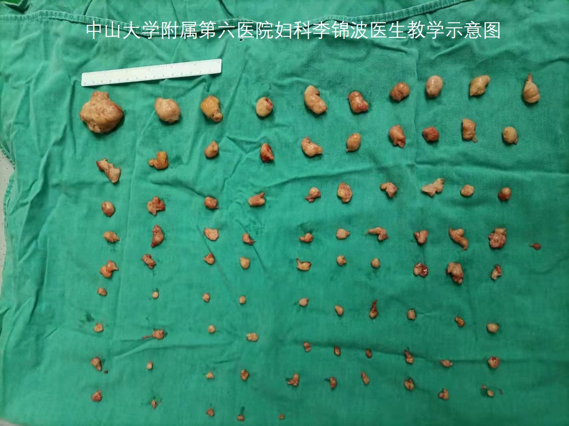 子宫肌瘤是不是必须做手术,子宫肌瘤做微创好还是手术开刀好