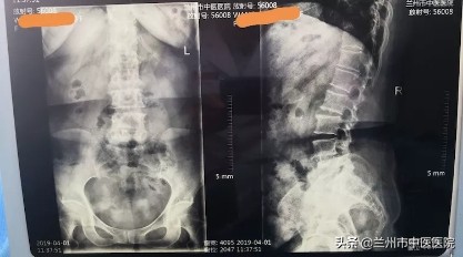 腰椎滑脱手术五十天伤口痛正常吗,银质针能治腰椎滑脱吗