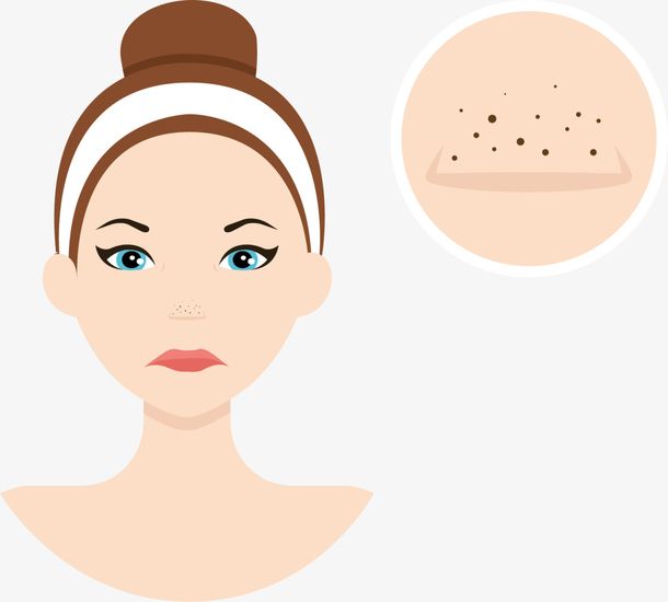 脸毛孔粗大黑头怎么解决,一招解决黑头的小妙招