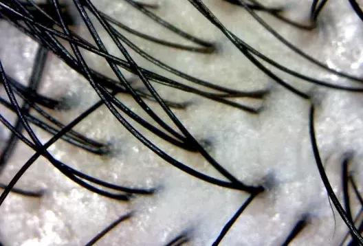 头发毛躁并且脱发推荐洗发水,用什么洗发水改善头皮脱发