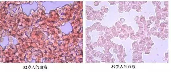 血液粘稠的病因及治疗,健康血液粘稠别小看但也别乱治