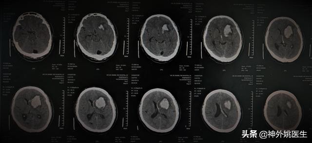 微创手术后血肿是什么,颅内血肿微创清除术多少钱