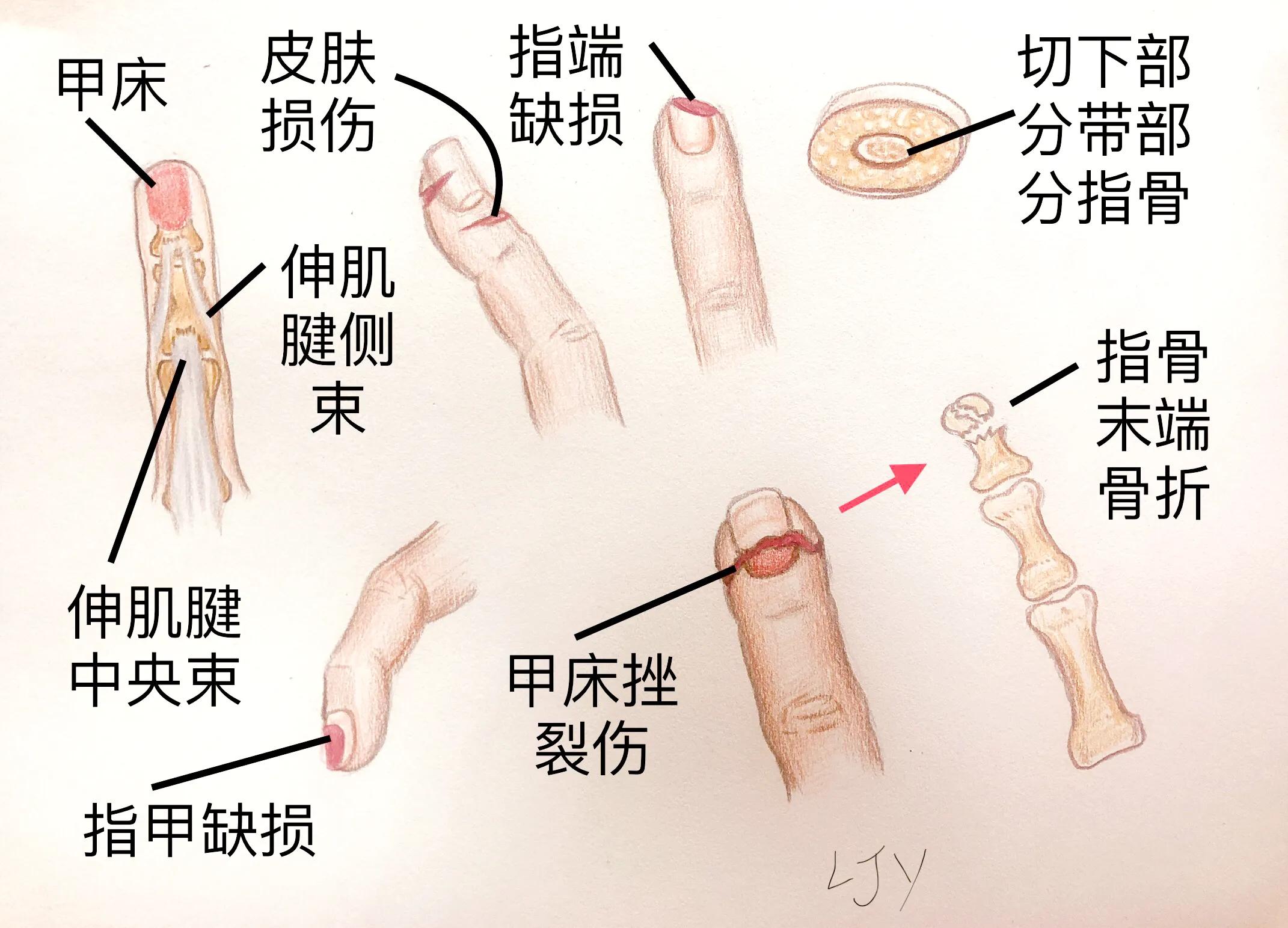 手被割伤如何处理,手被割伤了较深要如何处理
