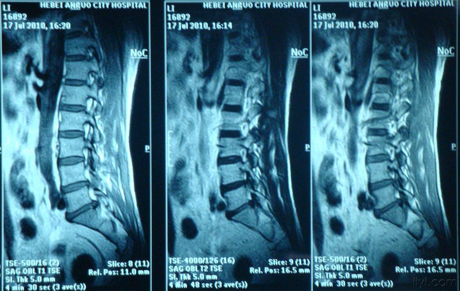 腰突压迫神经导致脚疼怎么办,脚痛无法形容的痛