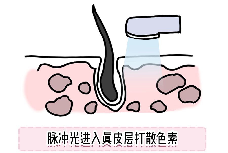 怕痛星人,怕痛选什么医美