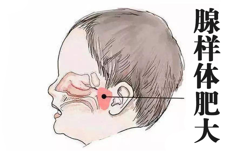 华西治疗打鼾最厉害的医生,华西治疗打鼾会先睡眠监测吗