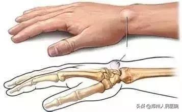 手腕疼10年了怎样治疗,20岁小伙手腕关节疼痛是怎么回事