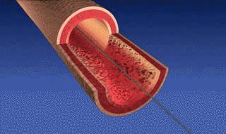 冠心病支架科普文,心内科冠脉支架