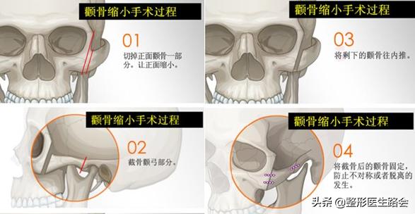 脸大颧骨高除了磨骨还有什么方法,颧骨高是选择磨骨还是填充鼻基底