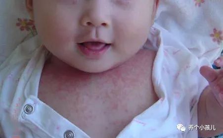 宝宝出现湿疹的原因和护理措施,高烧湿疹的症状及治疗方法