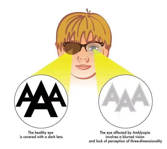 为什么我家两个孩子视力都弱视,12岁的孩子弱视和近视怎么治疗