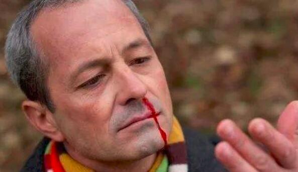 上火会不会导致鼻腔有血,上火会引起口鼻流血吗